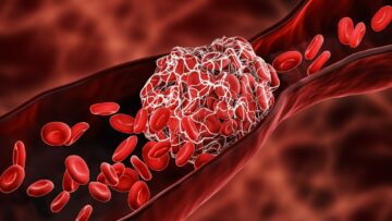 Review on nanoparticles usage for treating thrombosis induced by SARS-CoV-2 infections