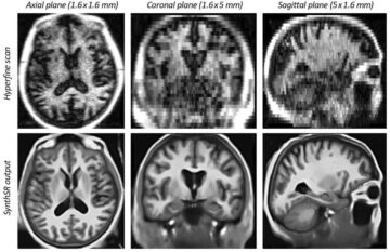 Η τεχνητή νοημοσύνη δημιουργεί εικόνες εγκεφάλου υψηλής ανάλυσης από σαρώσεις μαγνητικής τομογραφίας χαμηλής έντασης πεδίου