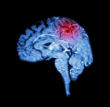 روغن شاهدانه برای بیماران سکته مغزی - آنچه جدیدترین مطالعات پزشکی به پزشکان می گوید