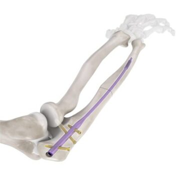 Conventus Flower Orthopedics объявляет о расширении своей технологической платформы Flex-Thread™ с разрешением FDA на систему интрамедуллярных стержней локтевой кости