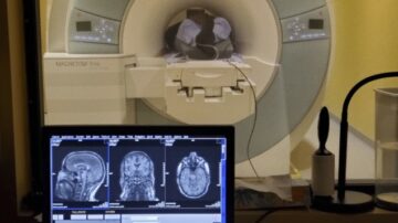 Stimulation des Gehirns mit 40 Hz zur Behandlung der Alzheimer-Krankheit