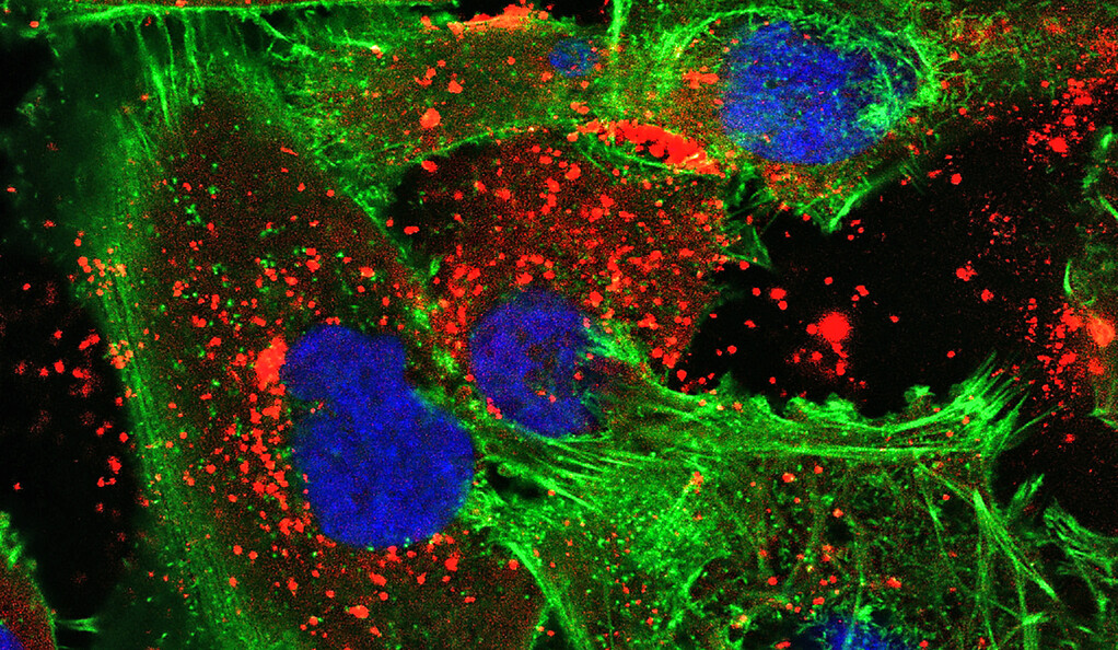 nanoparticles (red) are visible within human glioma tumor cells (green with blue nuclei)