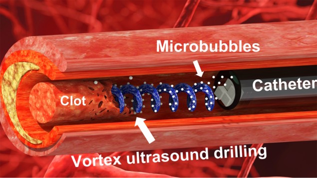 Instrumentul cu ultrasunete Vortex descompune cheaguri de sânge din creier