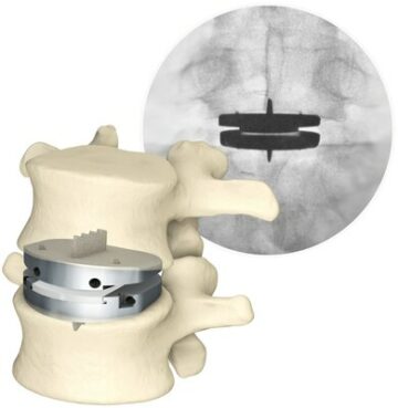 Aetna® aggiorna le linee guida per la sostituzione del disco; Tutti i principali pagatori ora coprono la sostituzione totale del disco lombare di Centinel Spine