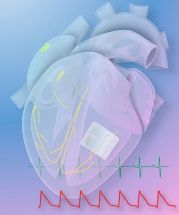 'Hình xăm' graphene điều trị rối loạn nhịp tim bằng ánh sáng