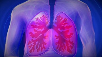 Mercy BioAnalytics zbere 41 milijonov dolarjev za presejalni test za pljučnega raka