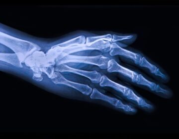 New injectable cell therapy shows promise for treating osteoarthritis