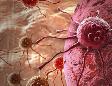 Ny nanopartikelsensor kan möjliggöra tidig cancerdiagnos med ett enkelt urintest