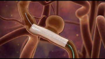 Intracranial Coil and Stent Retriever Guidelines Ask Your Feedback
