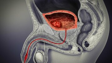 UroAmp detects bladder cancer 12 years before clinical signs, says study
