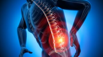 Relievant’s procedure provides long-term relief for chronic back pain