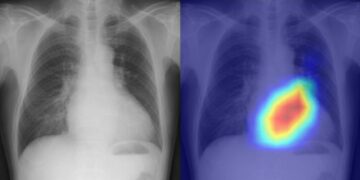 مدل یادگیری عمیق از اشعه ایکس قفسه سینه برای تشخیص بیماری قلبی - دنیای فیزیک استفاده می کند