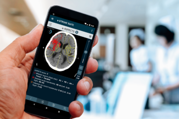AI stroke imaging platform boosts patient treatment rates