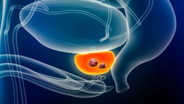 Telix behandelt den ersten chinesischen Patienten in einer Studie zur Bildgebung von Prostatakrebs