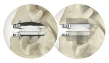 2,500 procedimentos concluídos nos EUA com o sistema de substituição total de disco cervical prodisc® C Vivo e prodisc C SK da Centinel Spine, menos de um ano após o lançamento limitado | Bioespaço