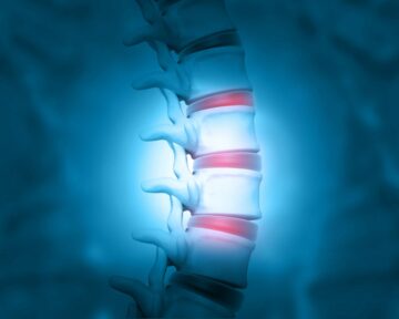 FDA、椎間板変性疾患研究におけるHYDRAFILシステムのIDEを承認