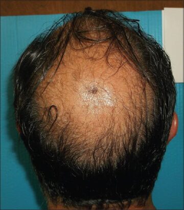 W nowym badaniu dotyczącym łysienia ekstrakt z konopi odwracał wypadanie włosów