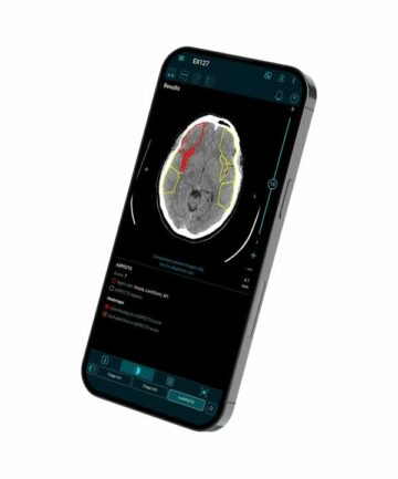 Brainomix выходит на территорию США с помощью платформы искусственного интеллекта