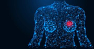 GE HealthCare представляет новую платформу искусственного интеллекта для визуализации рака молочной железы