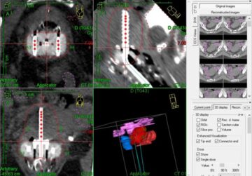 RadCalc QA software verifies non-standard treatment plans for HDR brachytherapy – Physics World