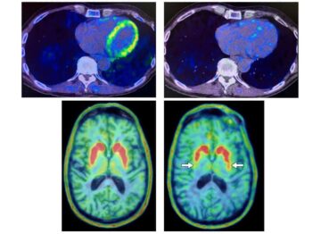 Cardiale PET-scans kunnen het begin van neurodegeneratieve ziekten bij risicopersonen voorspellen – Physics World