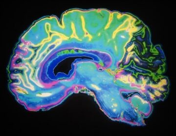 UC San Diego mengembangkan implan saraf revolusioner untuk perekaman otak dalam