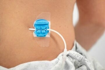 Cook offre ora i dispositivi di fissaggio del catetere Bedal FlexGRIP® per il comfort del paziente e la libertà di movimento | BioSpazio