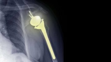 Exactech and Statera partner to develop smart reverse shoulder implant