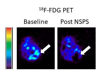 Novel cancer nanodrug targets tumor acidity without harming healthy tissue