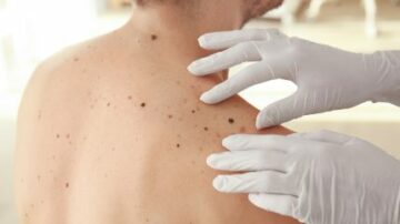 Castle Biosciences paljastaa melanoomatestitutkimuksen tulokset SSO 2024 -tapahtumassa