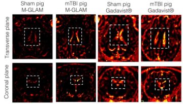 Makrofaagidele kleepuvad mikroplaastrid võimaldavad MRI-ga tuvastada ajupõletikku – Physics World