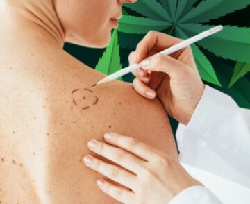 De diagnose van melanoom neemt explosief toe en cannabis kan nu voor veel patiënten deel uitmaken van de behandelingsoplossing