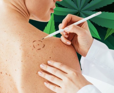 melanoma skin cancer marijuana