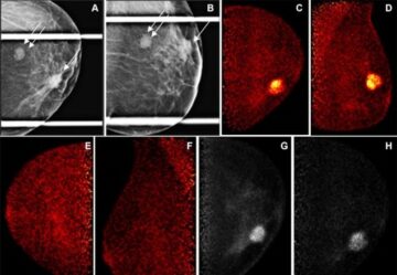 Molekulare Bildgebungstechnik könnte Brustkrebs-Screening verbessern – Physics World