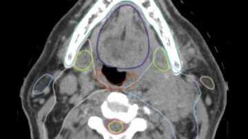 RefleXion to incorporate Limbus software into radiotherapy planning system