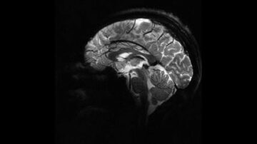 CEA Perancis mengungkap gambar otak manusia pertama dari MRI canggih di dunia