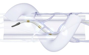 Medtronic Gains NMPA Approval for Renal Denervation Device; Already Used in GBA for Half a Year