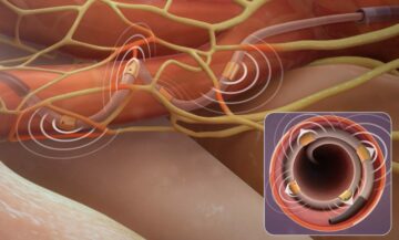 NMPA Review Report Released for Medtronic’s Renal Denervation Device